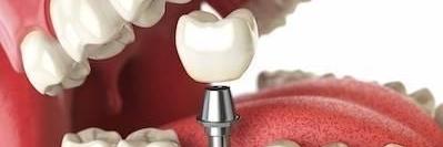 Dentures