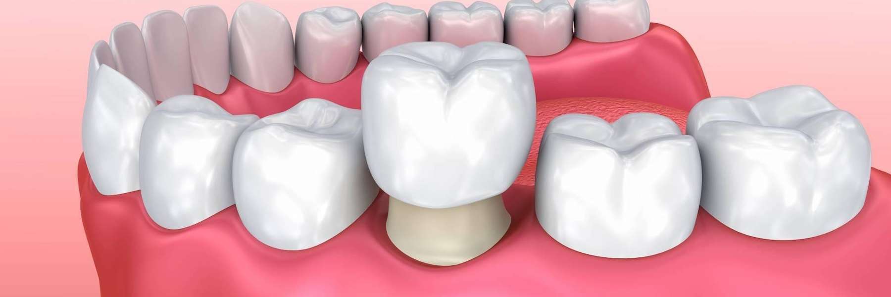 close up of dental crown in mouth | dentist garland tx