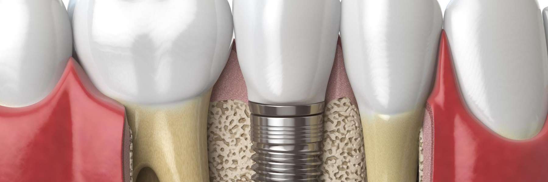 Root Canal Treatment