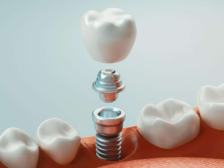 close up of parts of a dental implant | dental implants garland tx