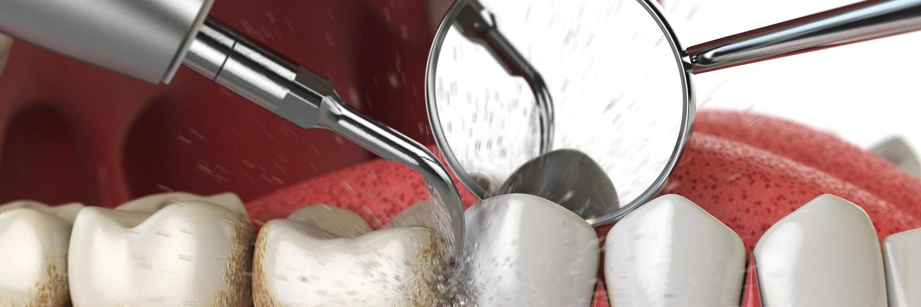 close up of dental tools in mouth | dental offices garland tx