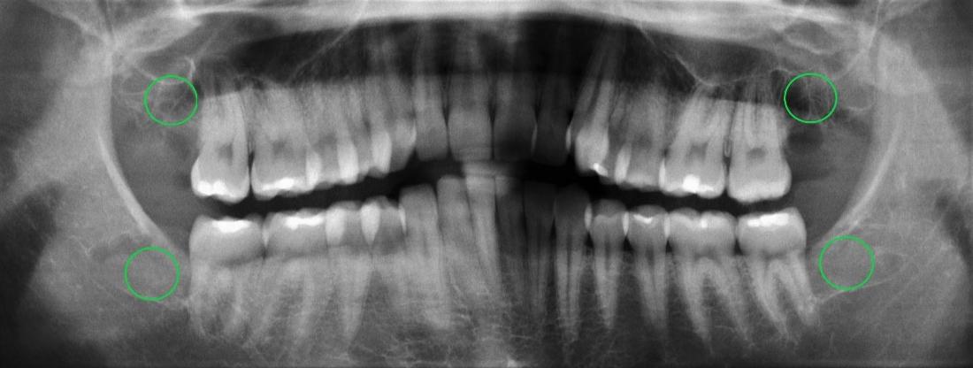 wisdom teeth before and after