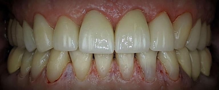Crown-and-Tooth-Color-Filling-Dental-Bonding-After-Image