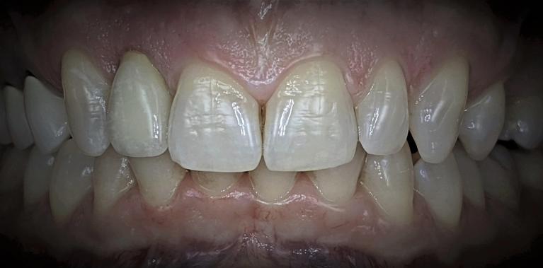 Dental-Implant-After-Image