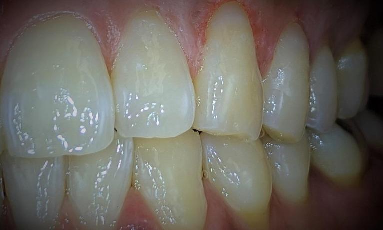 Tooth-Color-Filling-After-Image