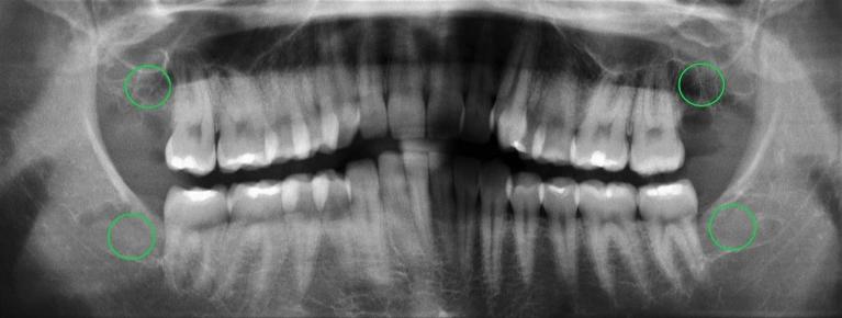 Wisdom-Teeth-Extraction-After-Image