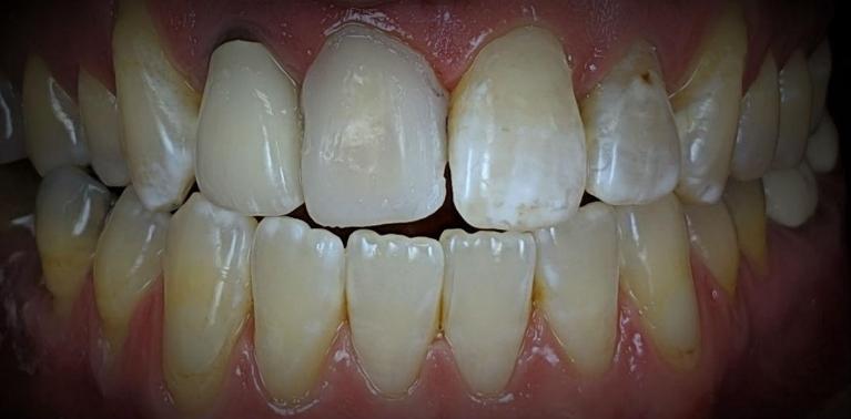 Front-Tooth-Crown-8-Before-Image
