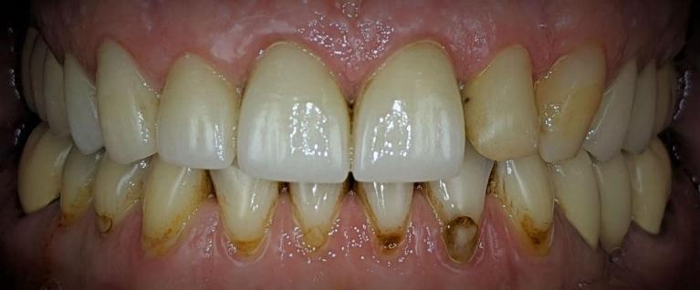 Crown-and-Tooth-Color-Filling-Dental-Bonding-Before-Image