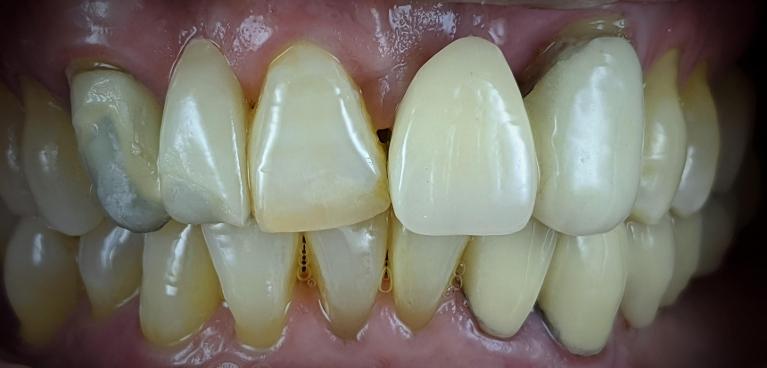 Dental Bridge