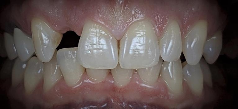 Dental-Implant-Before-Image