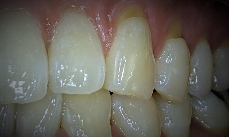 Tooth-Color-Filling-Before-Image