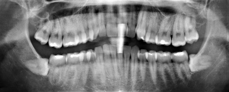 Wisdom-Teeth-Extraction-Before-Image