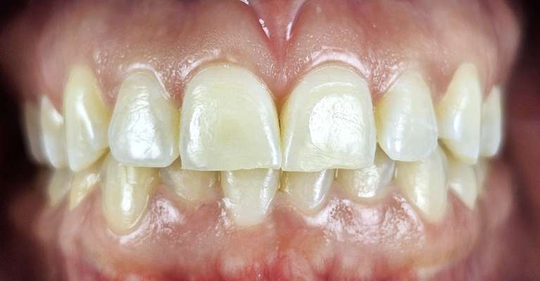 gummy smile correction Garland- After