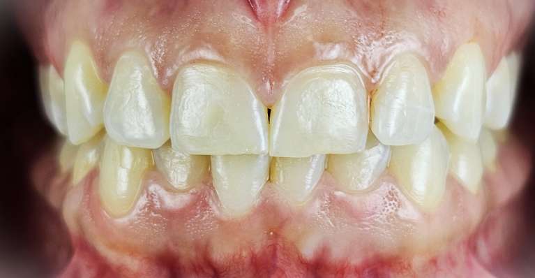 gummy smile correction Garland- Before